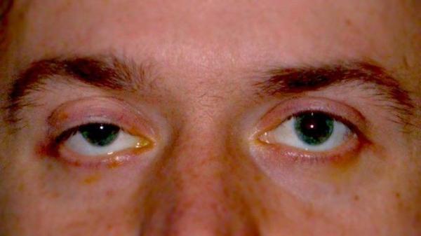 اشک ریزی مداوم نشانه کدام اختلال چشمی است؟