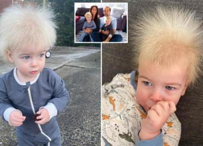 کودک مبتلا به سندرم موهای شانه نشونده